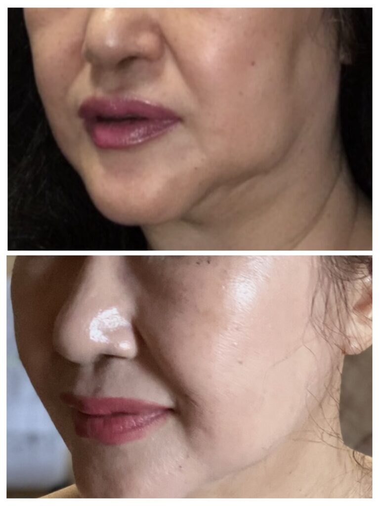 アンチエイジング美容液KEFENI使用